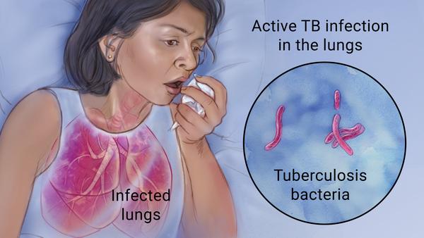 Pengidap HIV/AIDS Berisiko Terkena TBC yang Lebih Parah